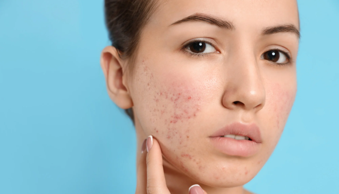 different-types-of skin-blemishes-blog