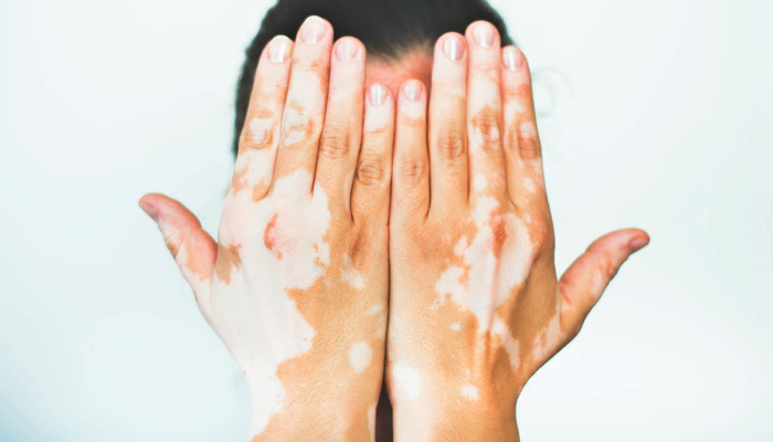 vitiligo-treatment-blog