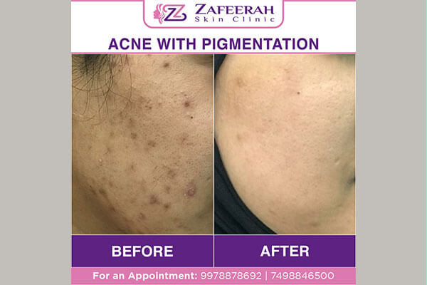 Before and after acne pigmentation treatment at zafeerah skin clinic mumbai & navi mumbai