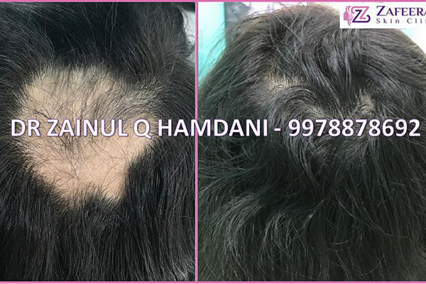 before and after alopecia areata treatment at zafeerah skin clinic mumbai & navi mumbai
