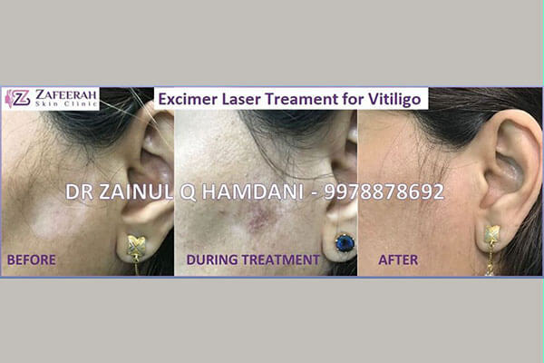 before and after excimer laser treatment for vitilogo at zafeerah skin clinic mumbai & navi mumbai