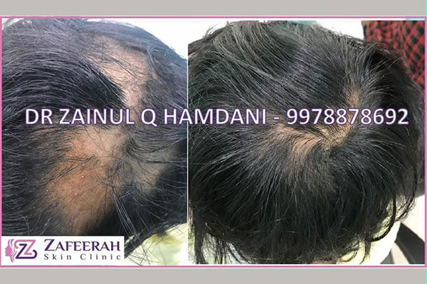 Before and after hair loss treatment at zafeerah skin clinic mumbai & navi mumbai