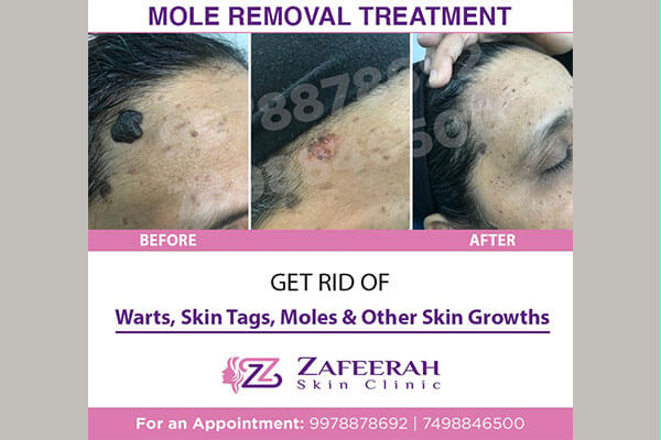 Before and after mole removal treatment at zafeerah skin clinic mumbai & navi mumbai