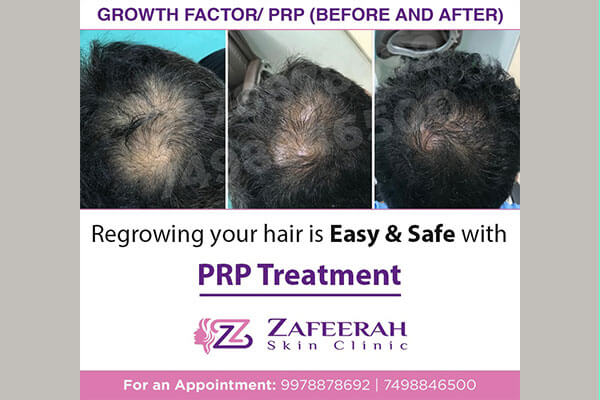 Before and After prp treatment at zafeerah skin clinic mumbai & navi mumbai