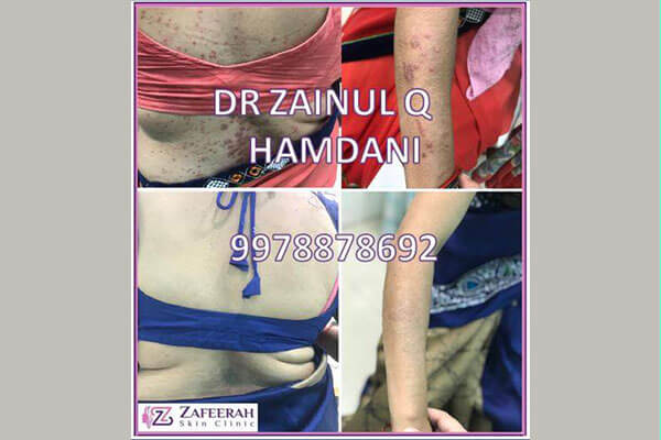 Before and after skin condition treatment at zafeerah skin clinic mumbai & navi mumbai