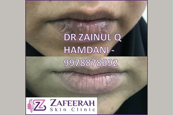 before and after skin problem and condition treatment at zafeerah skin clinic mumbai & navi mumbai