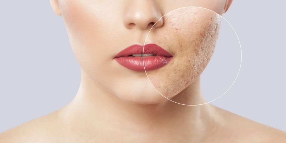 acne-scar-pigmentation-clinic