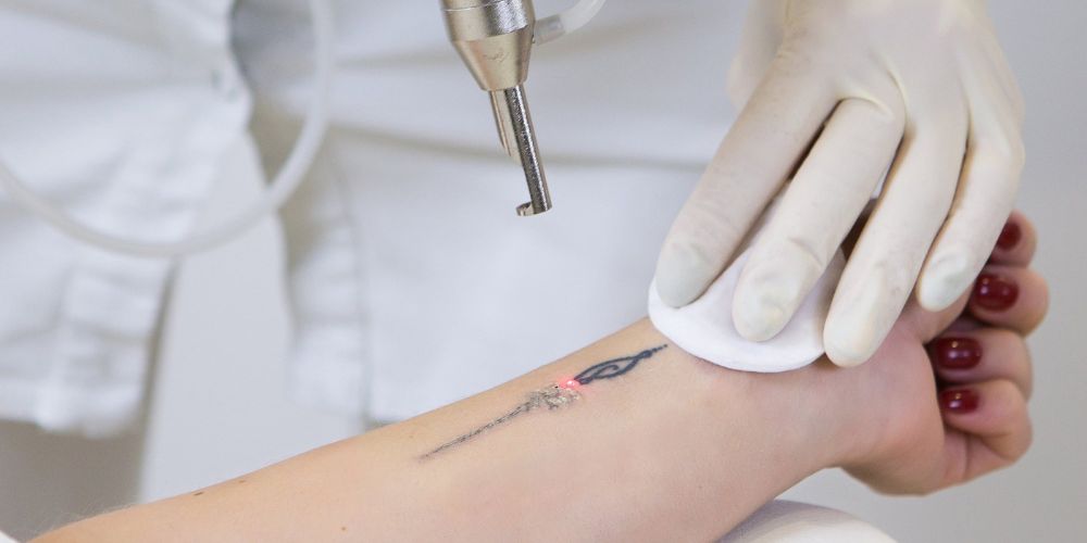 laser-tattoo-removal