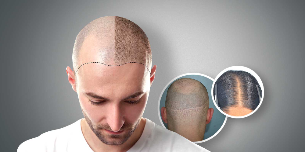 scalp-micropigmentation